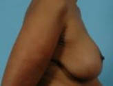 Patient # 32675 After Photo # 6
